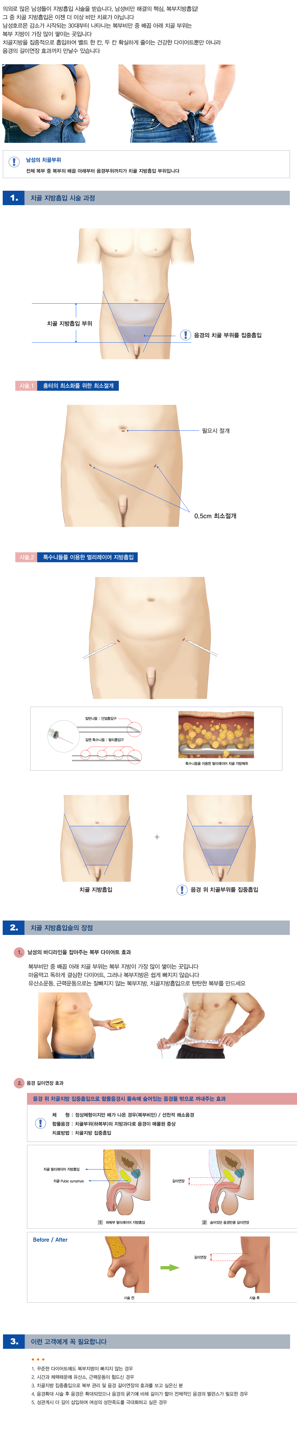 치골지방흡입